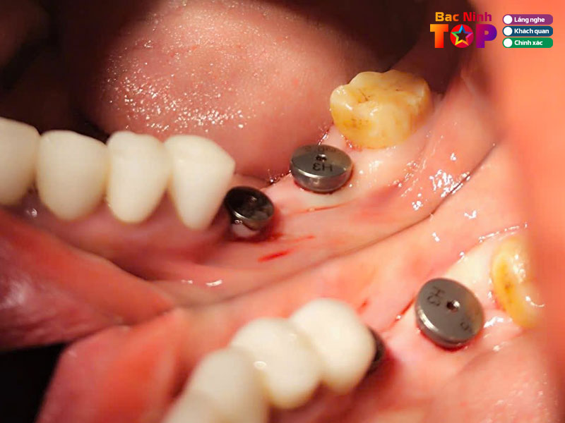 Nha-khoa-bao-anh-bacninhtoplist