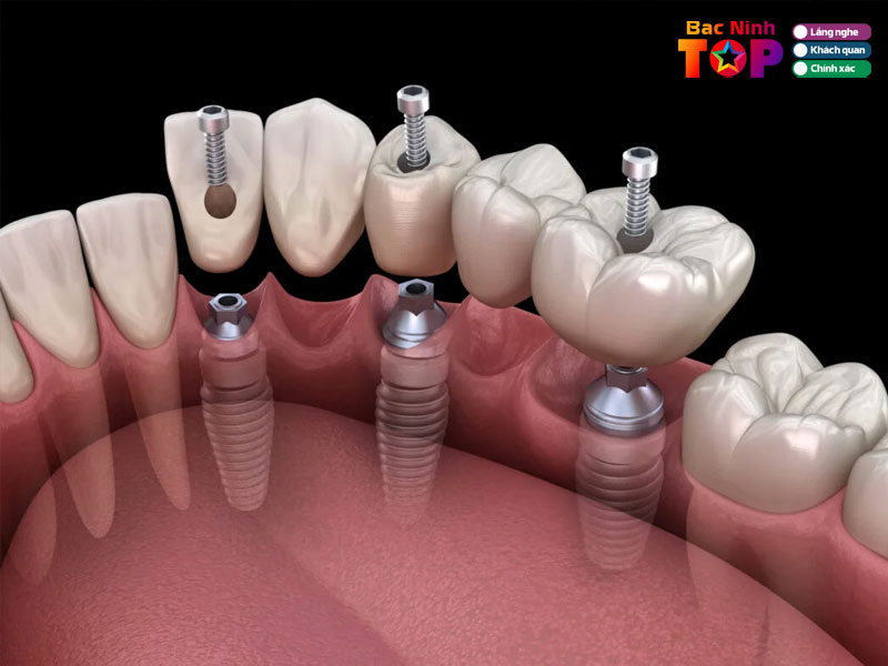 Tieu-chi-lua-chon-nha-khoa-trong-rang-implant-tai-bac-ninh-chat-luong-bacninhtoplist