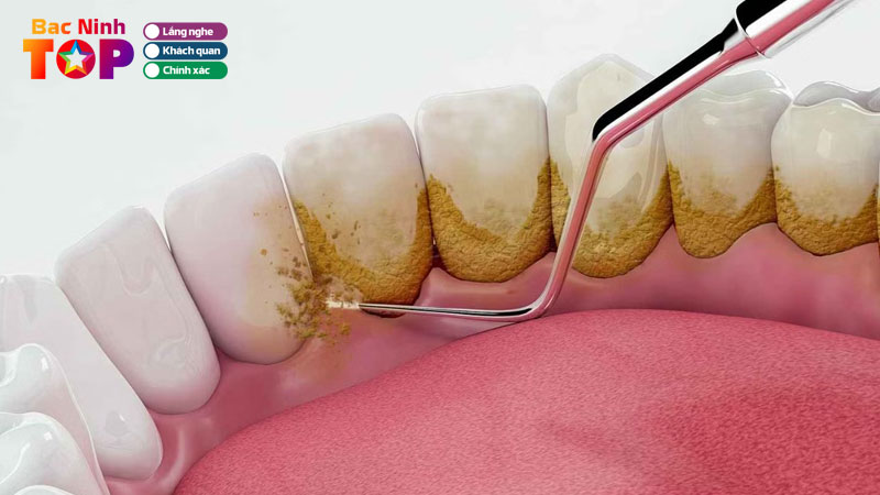 Top-10-dia-chi-cao-voi-rang-o-bac-ninh-em-ai-khong-e-buot-bacninhtoplist