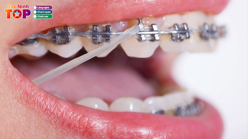 Top-10-dia-chi-nieng-rang-tai-bac-ninh-mang-lai-nu-cuoi-xinh-bacninhtoplist