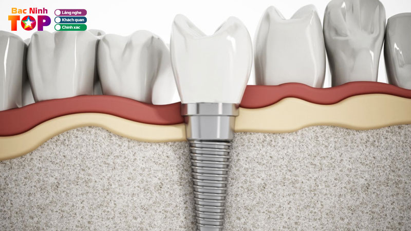 Top-11-nha-khoa-trong-rang-implant-tai-bac-ninh-an-toan-nhat-bacninhtoplist