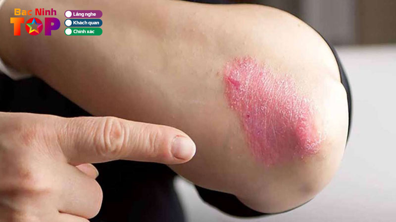 Top-10-phong-kham-da-lieu-tai-bac-ninh-hieu-qua-tan-tam-bacninhtoplist